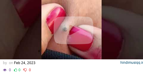 Giant Blackhead Removal from Back 0.1 ! pagalworld mp3 song download