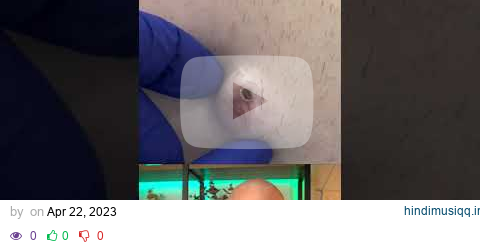 Doctor reacts to MASSIVE cyst! #dermreacts #doctorreacts #pimplepop #cystpop pagalworld mp3 song download